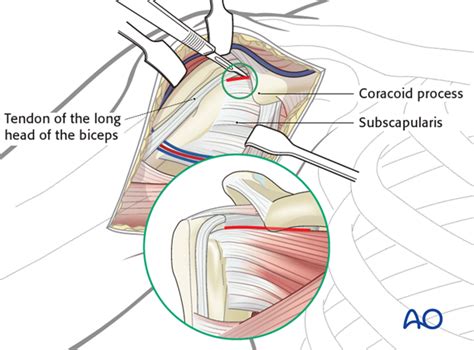 ao surgery reference|ao surgery reference deltopectoral approach.